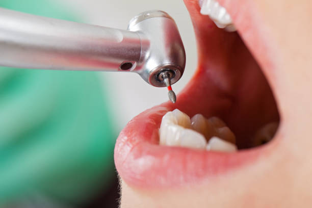Best Emergency Root Canal Treatment in Mianna, AR